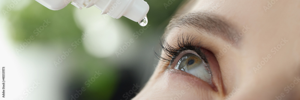 Woman drips eye drops into eye for allergies closeup Woman drips eye drops into eye for allergies closeup