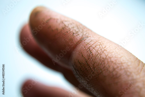 Fotografie Extremely dry, dehydrated and cracked skin of a man's hand with fragments of epidermis that exfoliate due to excessive use of alcohol-based disinfectants during coronavirus Covid-19 pandemic