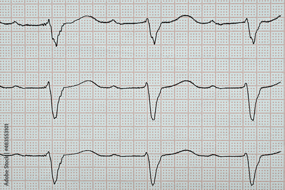 Elektrokardiogramm mit einem AV-Block ersten Grades