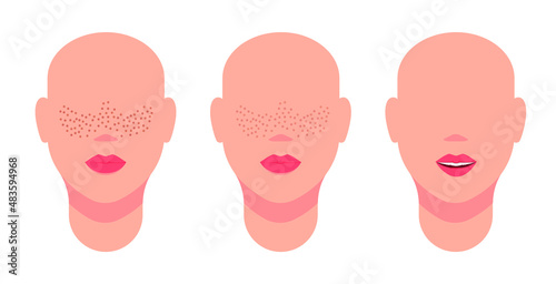 Woman's face with bright freckles, pale freckles and no pigmentation. Vector illustration, flat cartoon color design, isolated on white background, eps 10.