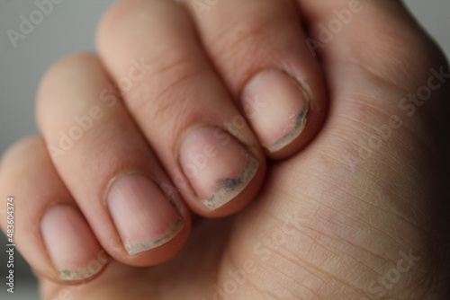 damaged damaged nail without manicure with dirt close-up. Nail Health Care