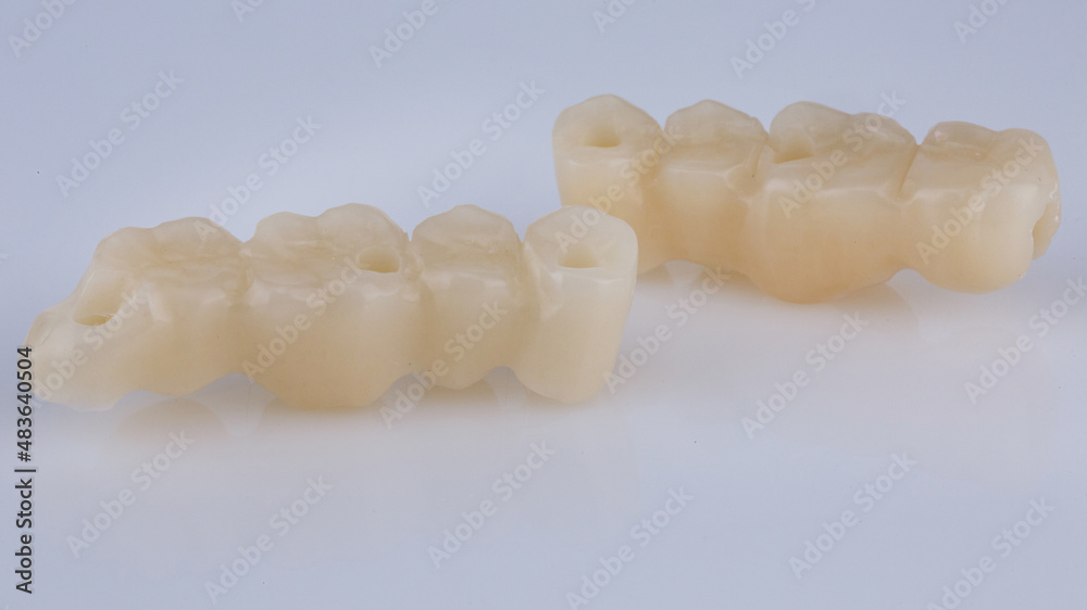 temporary dental bridges made of temporary wearing plastic on a white