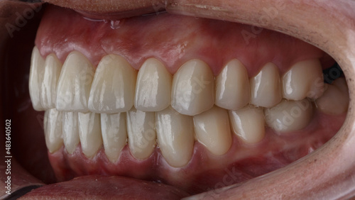beautiful teeth with ceramic dental crowns and inlays in the patient's mouth