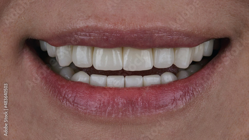 beautiful dental smile with ceramic crowns