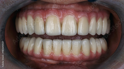 metal-ceramic dental prostheses of the upper and lower jaws in the patient's mouth