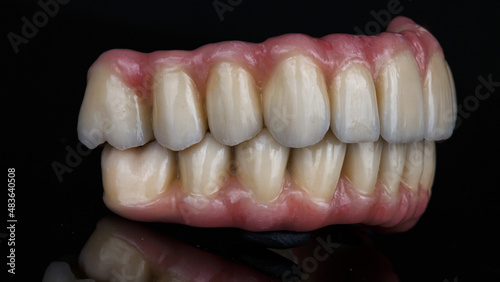 two dental prostheses in the bite with a pink gum on a black background