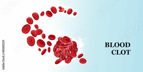 Blood clot thrombus medical poster