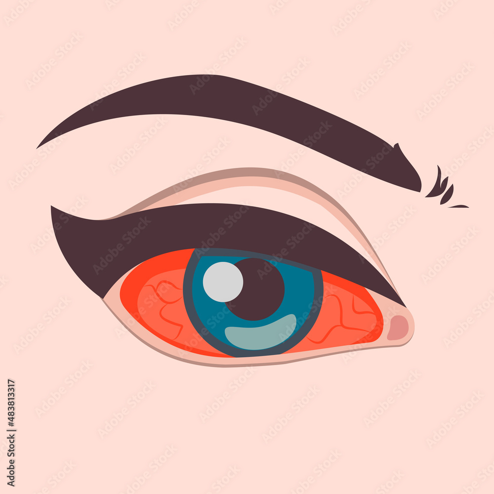 Disorder of eyes, Sore eyes, inflamed reddened eyes, red eyes icon. Vector illustration Disorder of eyes, Sore eyes, inflamed reddened eyes, red eyes icon. Vector illustration