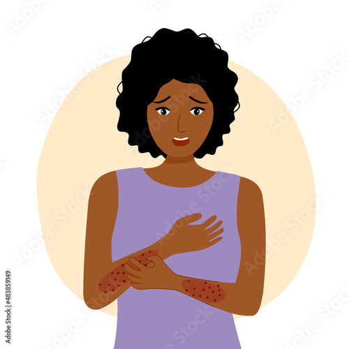 African woman scratching arm. Black female suffering from strong allergy skin itchy symptom in flat design. Red rash skin irritation.