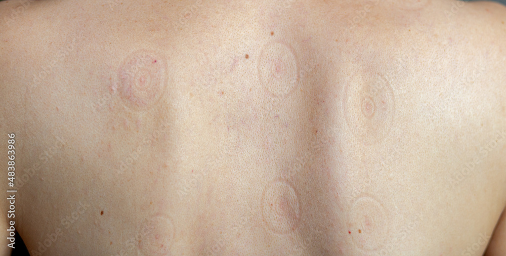 Fototapeta premium Man after a vacuum massage with cans. Hematoma after removal of medical cans. Acupressure of the back. Vacuum treatment of the back. Traces of treatment with cans on the back.