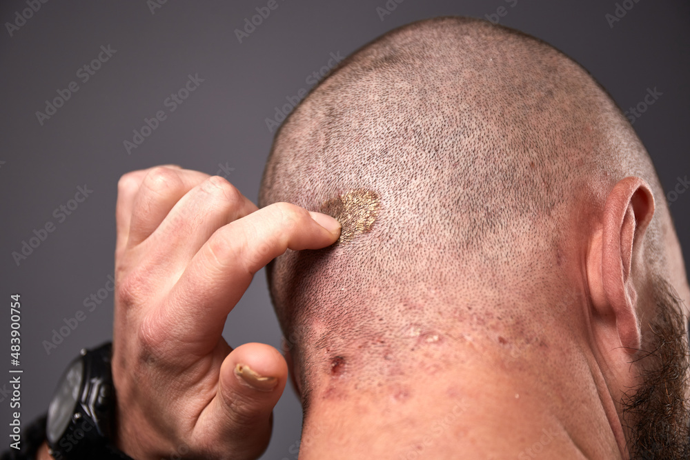 Man with dry flaky skin on his head with psoriasis and nail fungus on hands. Autoimmune genetic disease.