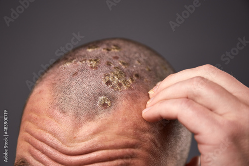 Man with dry flaky skin on his head with psoriasis and nail fungus on hands. Autoimmune genetic disease. photo