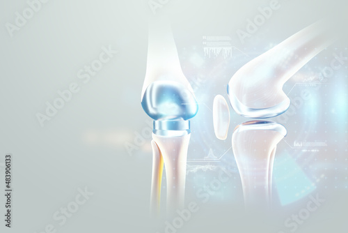 hip implant Medical poster, image of the bones of the knee, artificial joint in the knee. Arthritis, inflammation, fracture, cartilage,. Copy space, 3D illustration, 3D render. photo