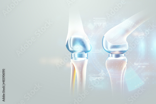 hip implant Medical poster, image of the bones of the knee, artificial joint in the knee. Arthritis, inflammation, fracture, cartilage,. Copy space, 3D illustration, 3D render.