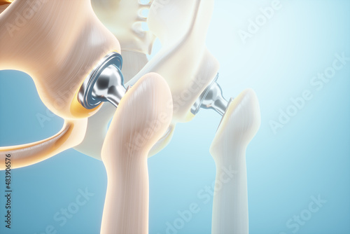 Medical poster image of a hip implant. artificial joint, Arthritis, inflammation, fracture, cartilage. 3D illustration, 3D render.