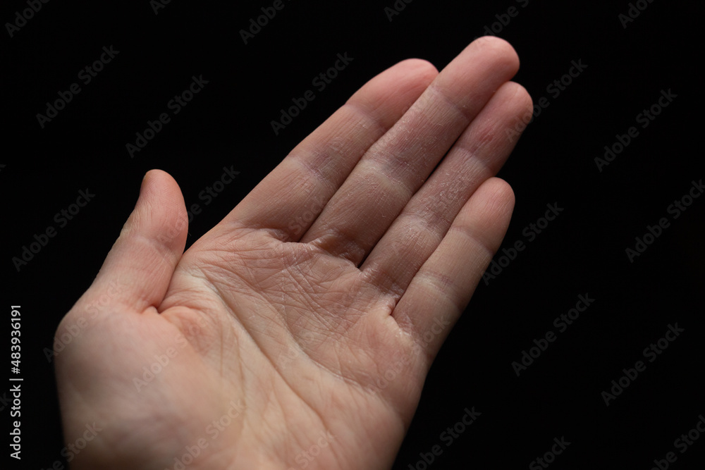 A woman is showing her dry and cracked skin caused by frequent disinfection.