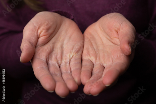 A woman is showing her dry and cracked skin caused by frequent disinfection.  © Anna
