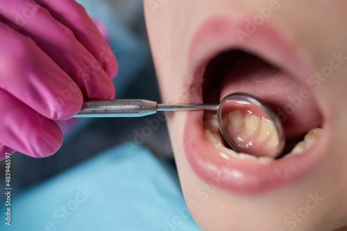 A close-up of a young girl getting a dental exam by dentist and using dental mirror to see baby teeth and gums. photo