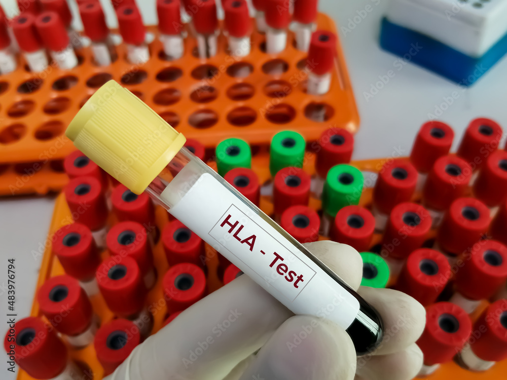 Test tube with blood sample for HLA (Human Leukocyte Antigen) test ...