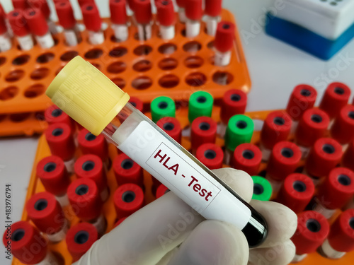 Test tube with blood sample for HLA (Human Leukocyte Antigen) test.