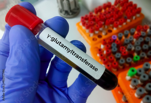 Blood sample for Gamma-glutamyl transferase or Gamma GT test, Liver enzyme photo