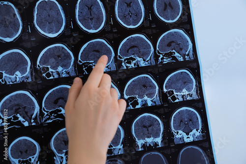 Doctor examining MRI images of patient with multiple sclerosis in clinic, closeup photo