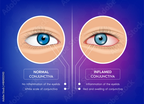 Normal conjunctiva and Conjunctivitis.