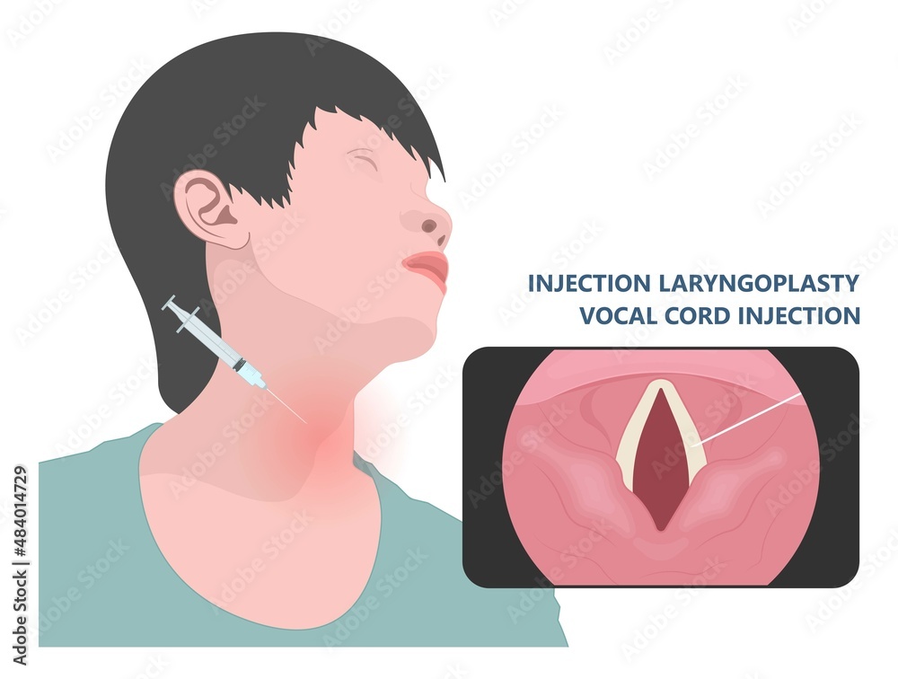 Sore loss cough virus viral acute swell sound folds treat cysts Palsy