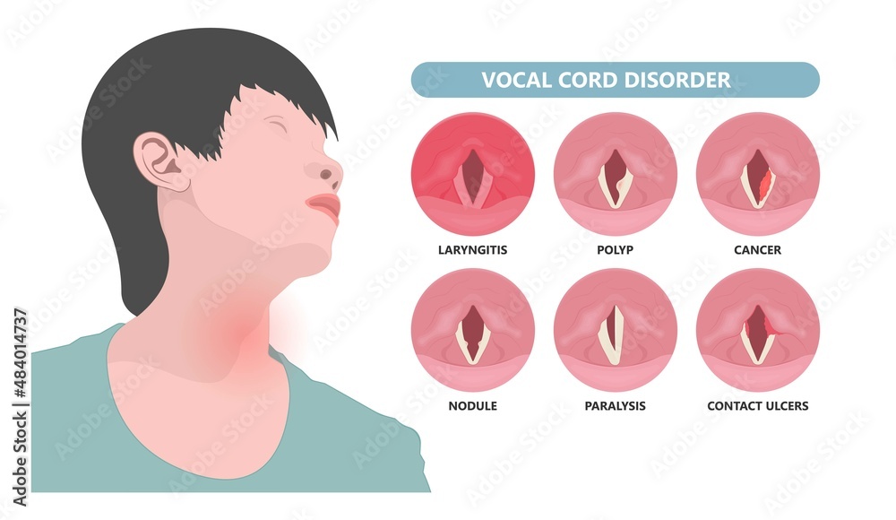 Vettoriale Stock Sore loss cough virus viral acute swell sound folds