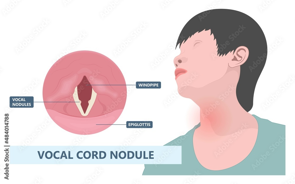 Sore loss cough virus viral acute swell sound folds treat cysts Palsy