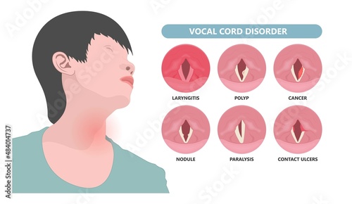 Sore loss cough virus viral acute swell sound folds treat cysts Palsy nerve Tumor botox throat hoarse larynx airway polyps Cancer injury speech damage Ulcers box chronic nodules surgery reflux upper