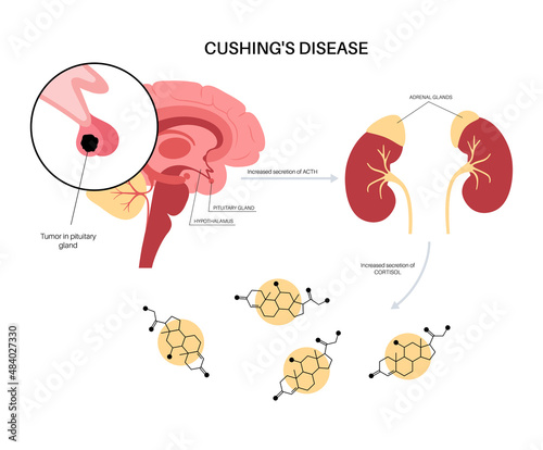 Cushing Desease poster