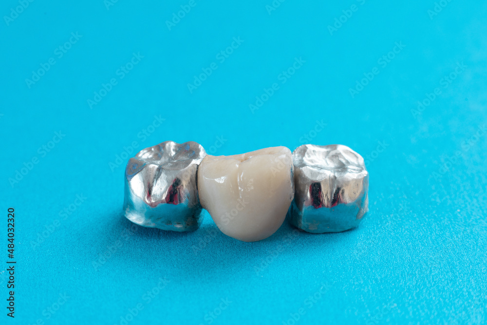 Dental crowns and ceramic-metal tooth for prosthetics close-up isolated on a blue background top view. Dental treatment Dental crowns and ceramic-metal tooth for prosthetics close-up isolated on a blue background top view. Dental treatment