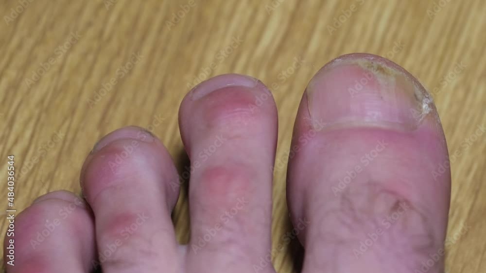 Vidéo Stock Onycholysis detachment of the nail from the nail bed. Fungal nail infection