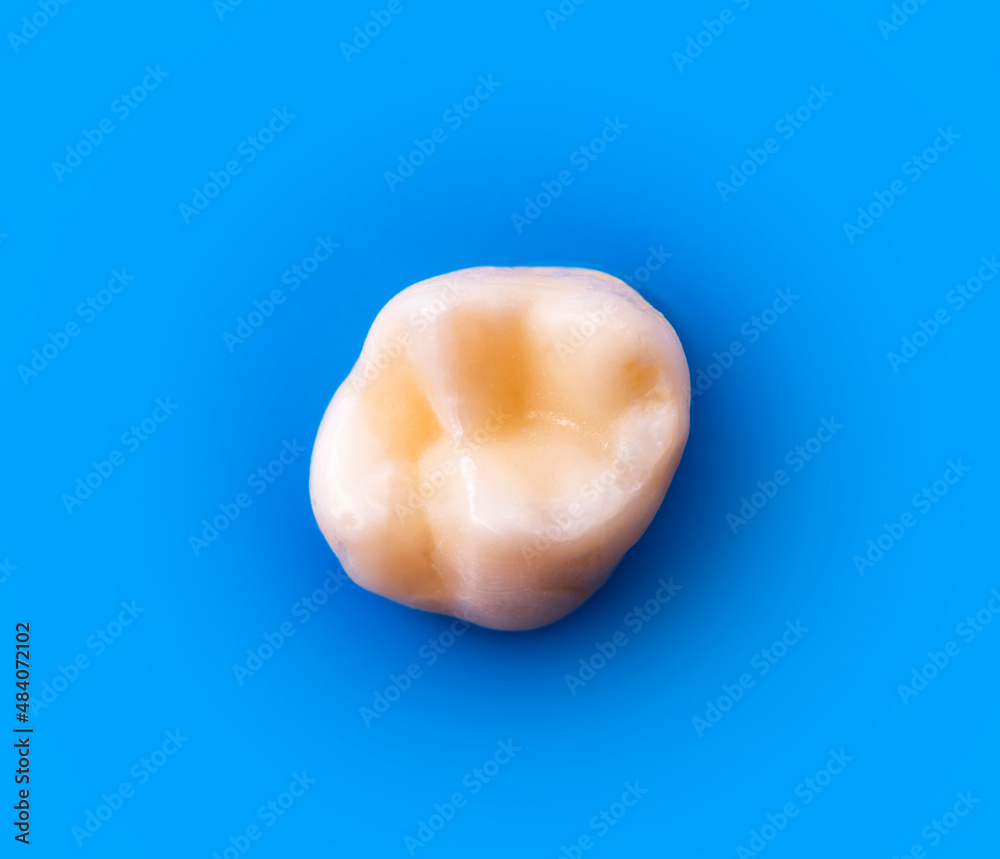 tooth restored by esthetic composite filling tooth restored by esthetic composite filling