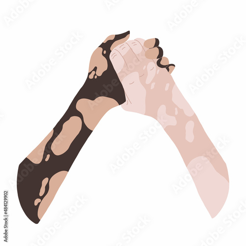 Hands with vitiligo disease. Support for people with skin pigmentation disorders. Different skin colors, different nationalities. Hand drawn illustration. Vector image on a white background