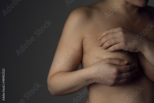 Breast cancer survivor woman show the scar on her chest following a mastectomy
