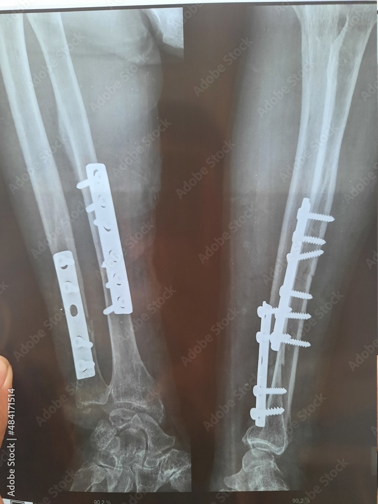 broken bone xray fracture patients Stock Photo Adobe Stock