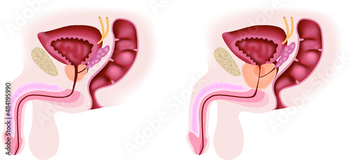 Benign prostatic hyperplasia side view