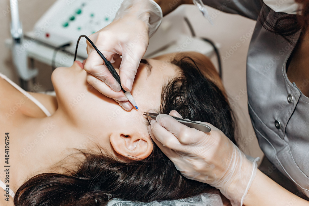 The process of permanent removal of unwanted facial hair using an electroepilation device and tweezers