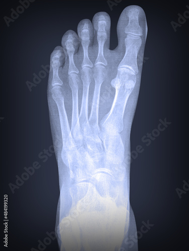 x-ray of a left foot with osteoporosis damage