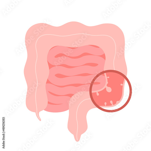 Colonoscopy intestine, polypectomy procedure, removal polyp in colon. Checkup gut, colon surgery. Operation intestine. Vector illustration