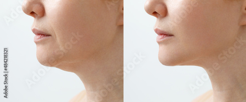 A close portrait of an aged woman before and after facial rejuvenation procedure. Correction of the chin shape liposuction of the neck. The result of the procedure in the clinic of aesthetic medicine.