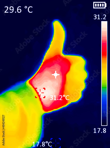 A thermographic image of a person's hand showing different temperatures in different colors, from blue indicating cold to red indicating hot, this may indicate inflammation of the joints.