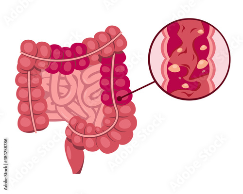 Human small and large intestine diseases. Inflammation or infection. Crohns disease. Internal organ, digestive tract on white background for medical and health concept. Vector illustration. photo