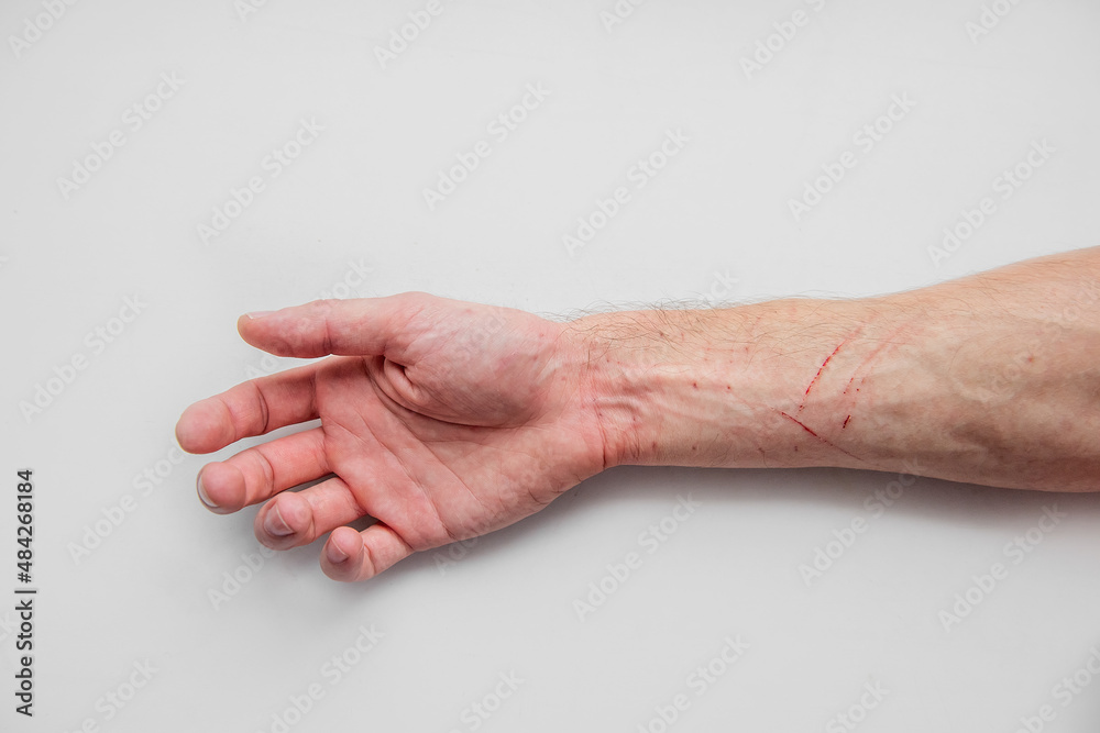 On white isolated background lies mans hand scratched by rabid cat. Medical care, hydrogen peroxide On white isolated background lies mans hand scratched by rabid cat. Medical care, hydrogen peroxide