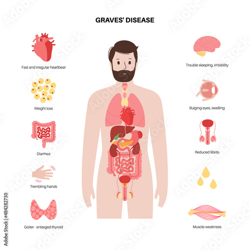 Graves desease symptoms photo