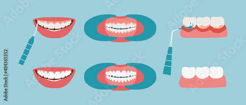 Tooth tartar cleaning. Oral cavity before and after using the water irrigator. Teeth with inflamed gums close-up, healthy smile. Collection flat vector illustration