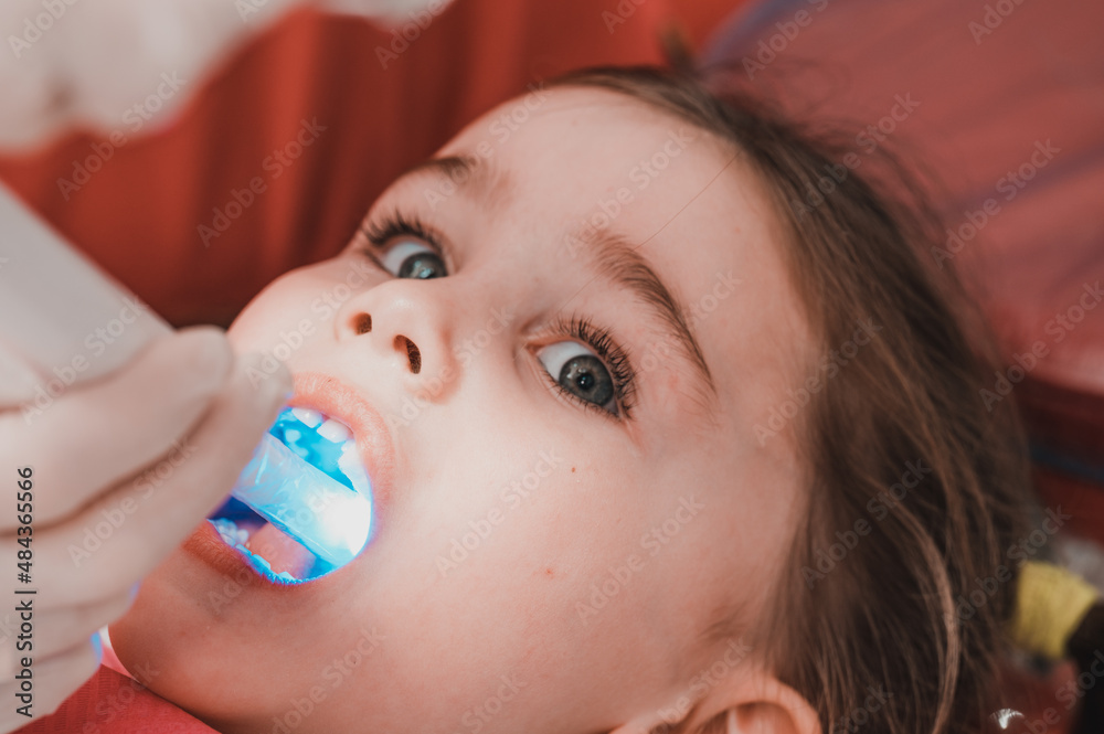 Ultraviolet light in dentistry, the dentist holds a device with ultraviolet light to quickly seal the filling in the child's tooth. Ultraviolet light in dentistry, the dentist holds a device with ultraviolet light to quickly seal the filling in the child's tooth.