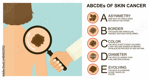 Diagnosis of skin cancer. Melanoma warning signs. Dermatological screening. UVB prevention of squamous cell treatment. Basal test. ABCDEs of skin cancer screening. 